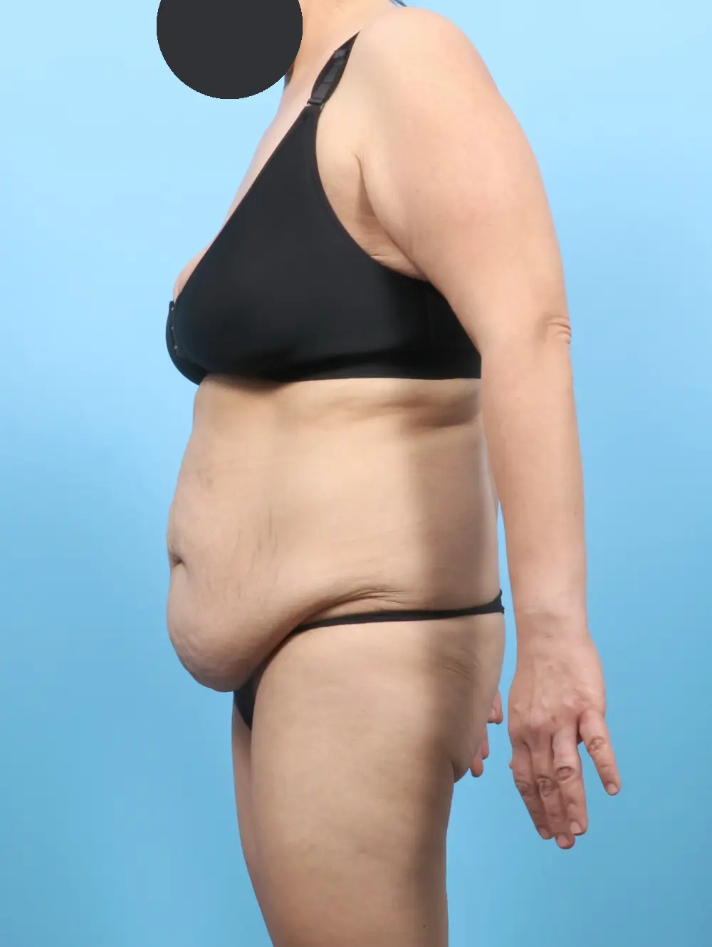 After Weight Loss Patient Photo - Case 56060 - before view-2