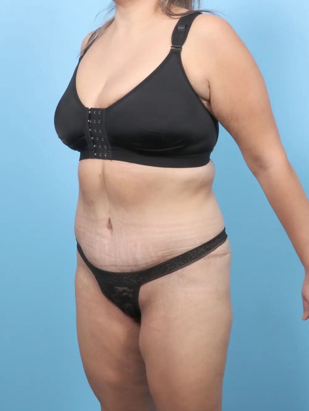 After Weight Loss Patient Photo - Case 56060 - after view-1