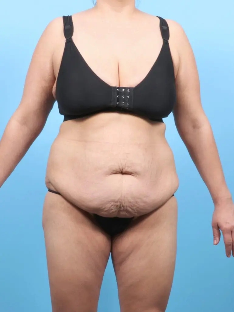 After Weight Loss - Case 56060 - Before