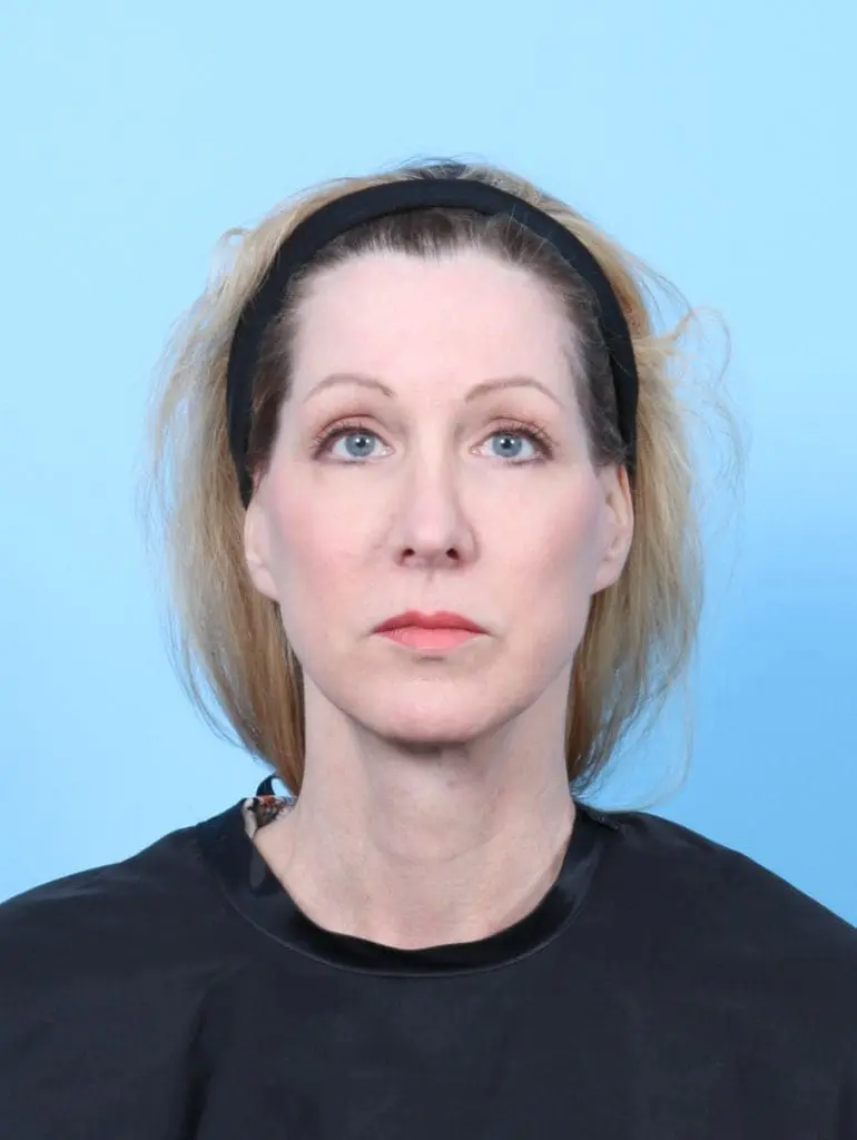 Brow Lift - Case 56110 - After