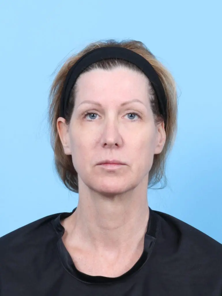 Brow Lift - Case 56110 - Before