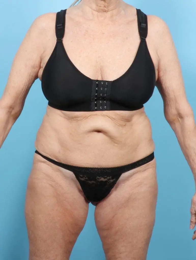 Tummy Tuck - Case 56178 - Before