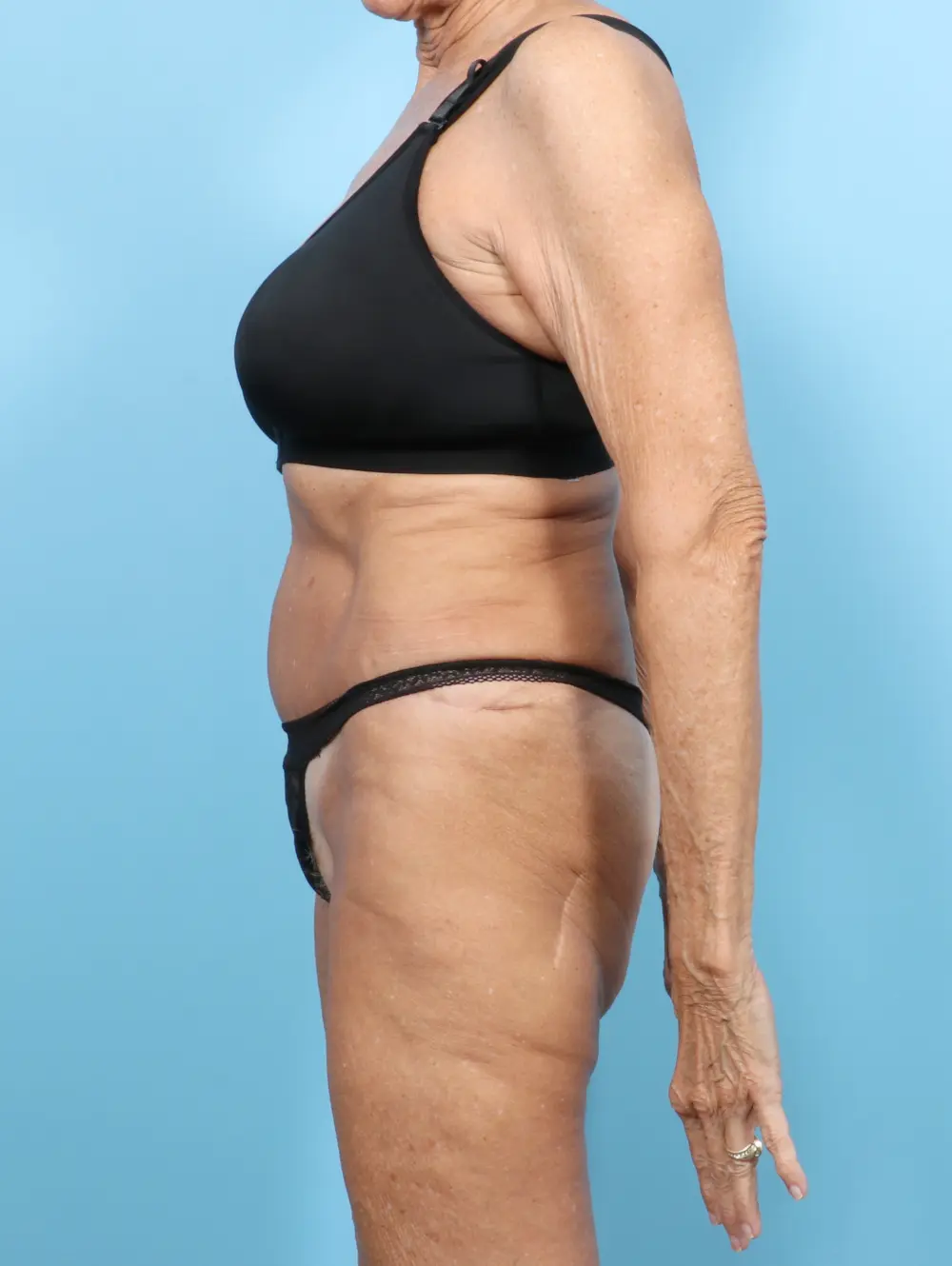 Tummy Tuck Patient Photo - Case 56178 - after view-2