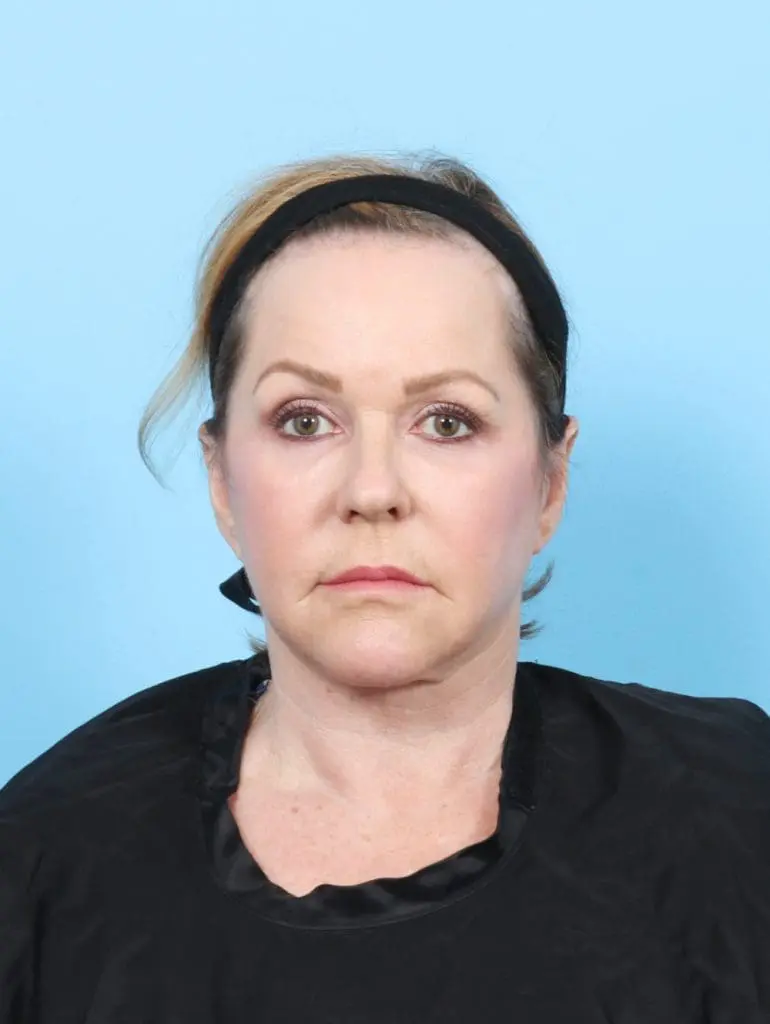 Facelift / Neck Lift - Case 56212 - After