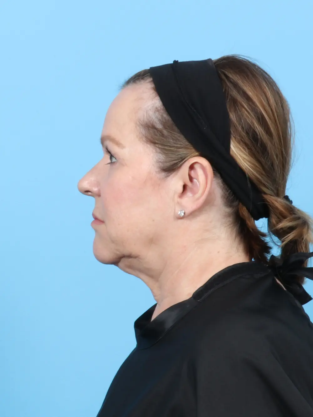 Facelift / Neck Lift Patient Photo - Case 56212 - before view-2