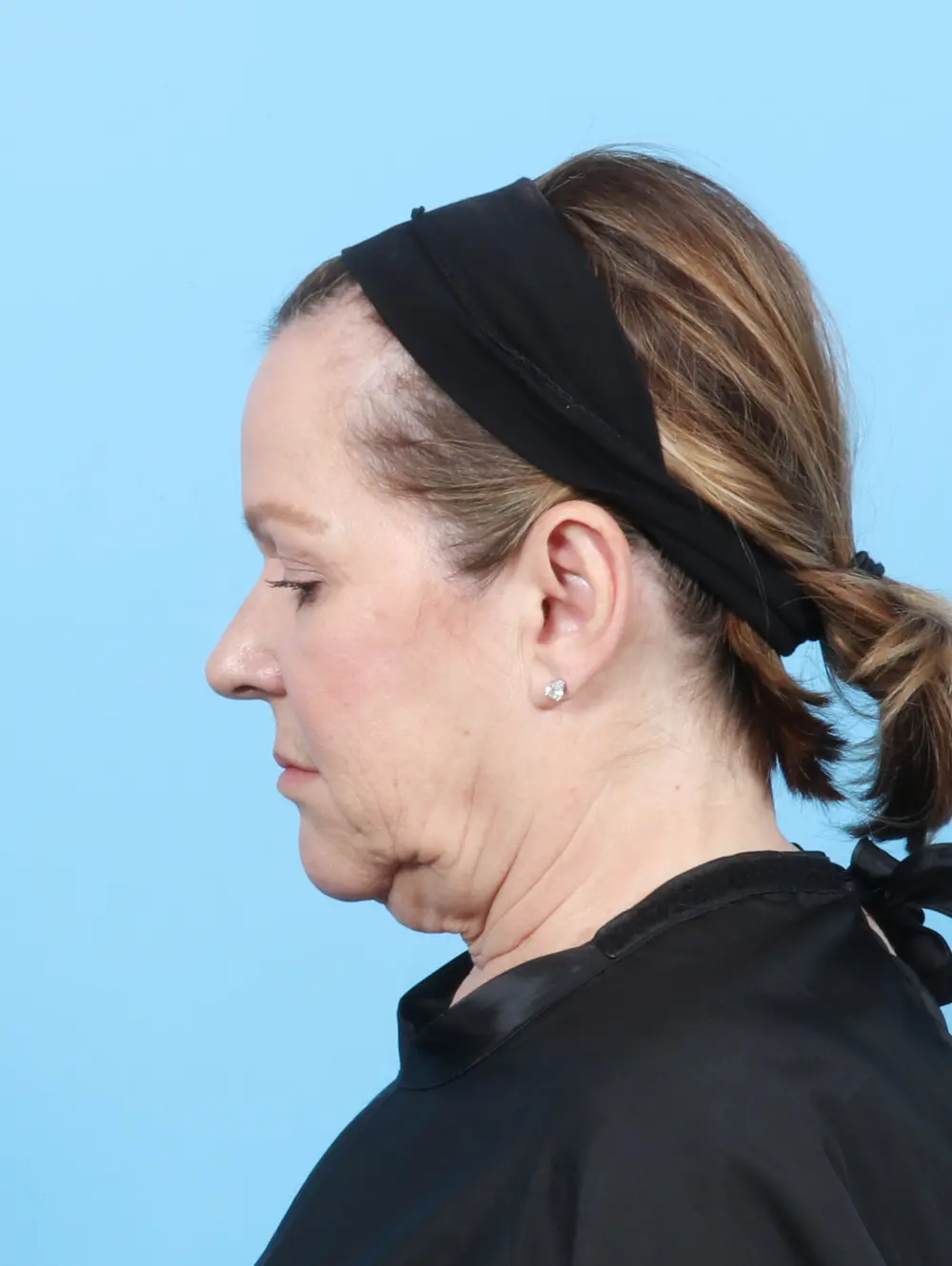 Facelift / Neck Lift Patient Photo - Case 56212 - before view-3