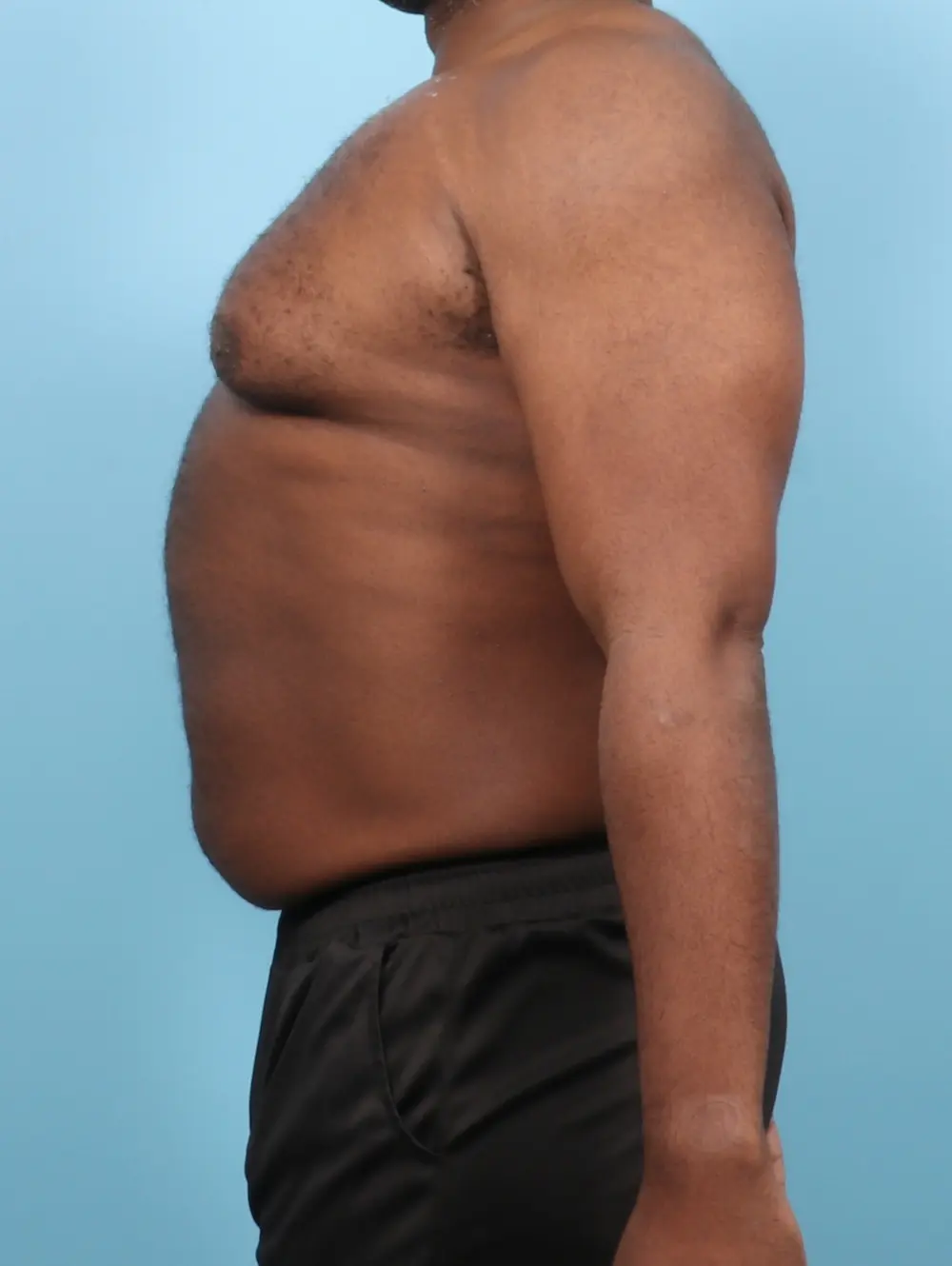 Gynecomastia Patient Photo - Case 56222 - before view-2