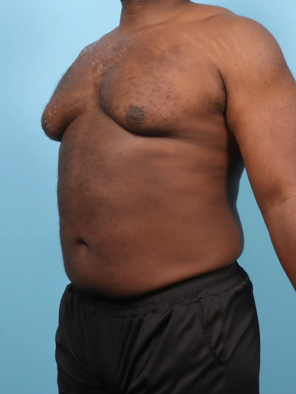 Gynecomastia Patient Photo - Case 56222 - before view-1