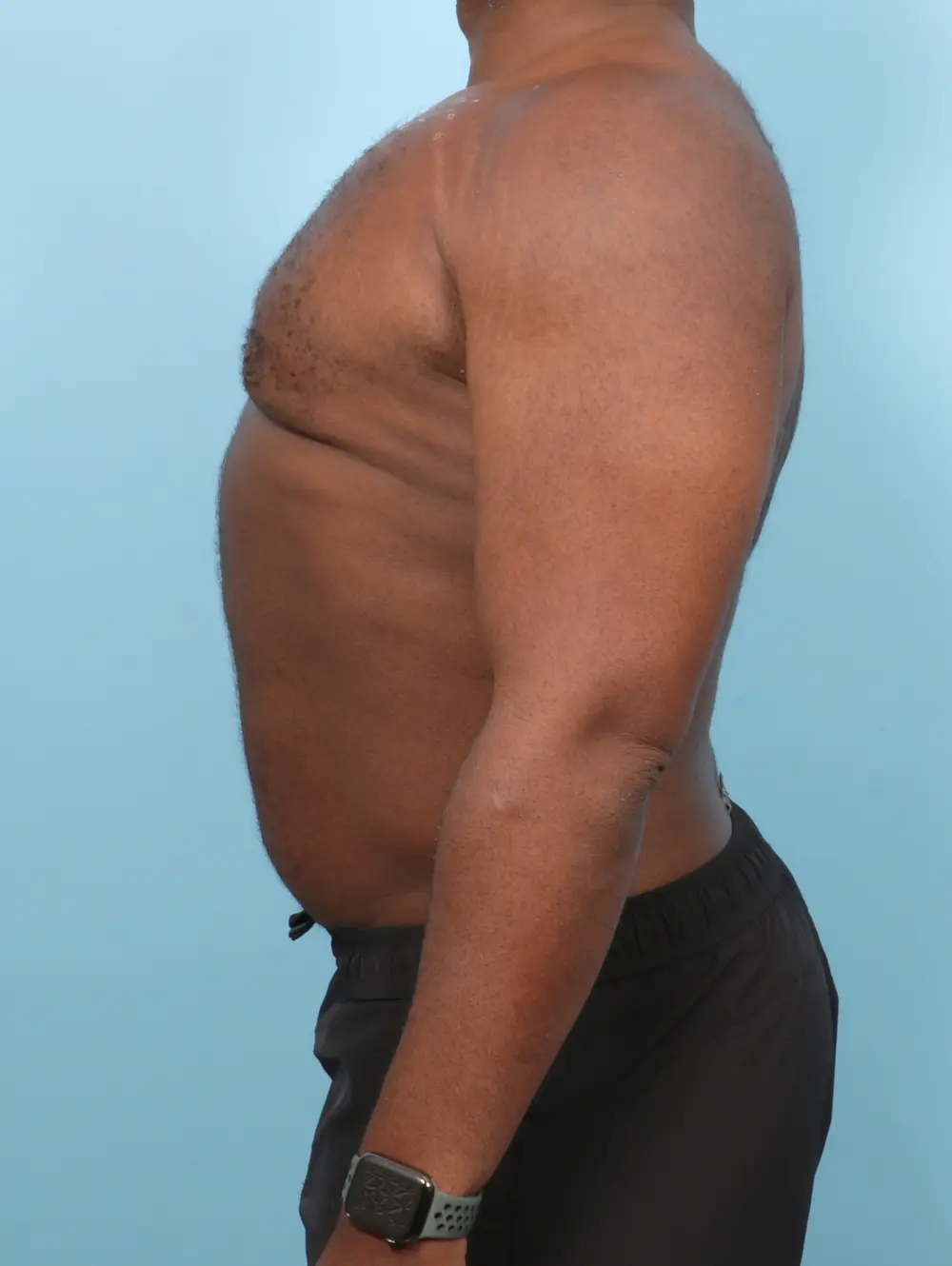 Gynecomastia Patient Photo - Case 56222 - after view-2
