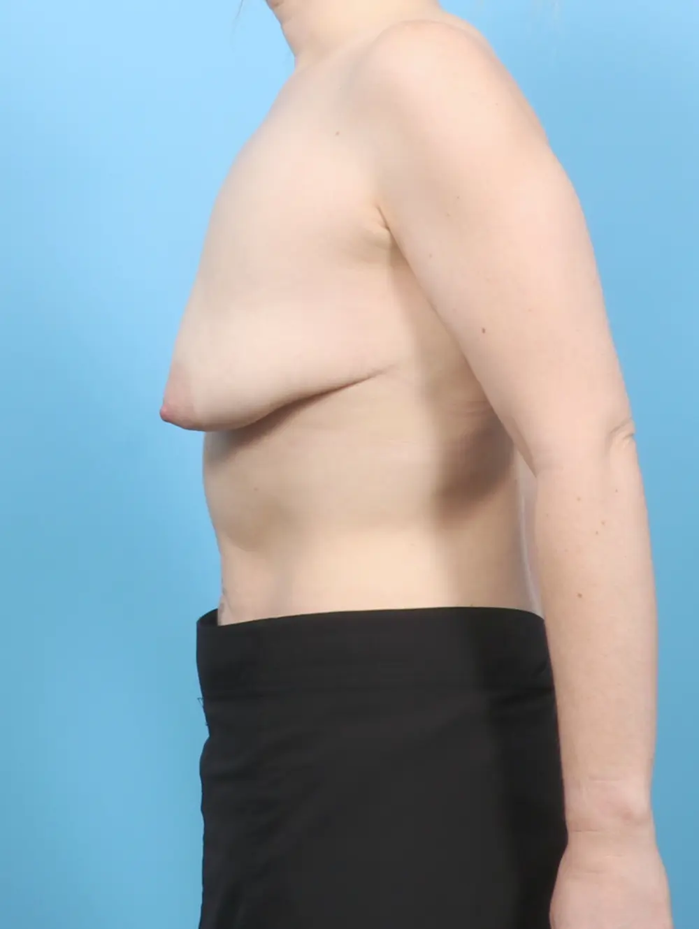 Breast Lift/Reduction with Implants Patient Photo - Case 56230 - before view-2
