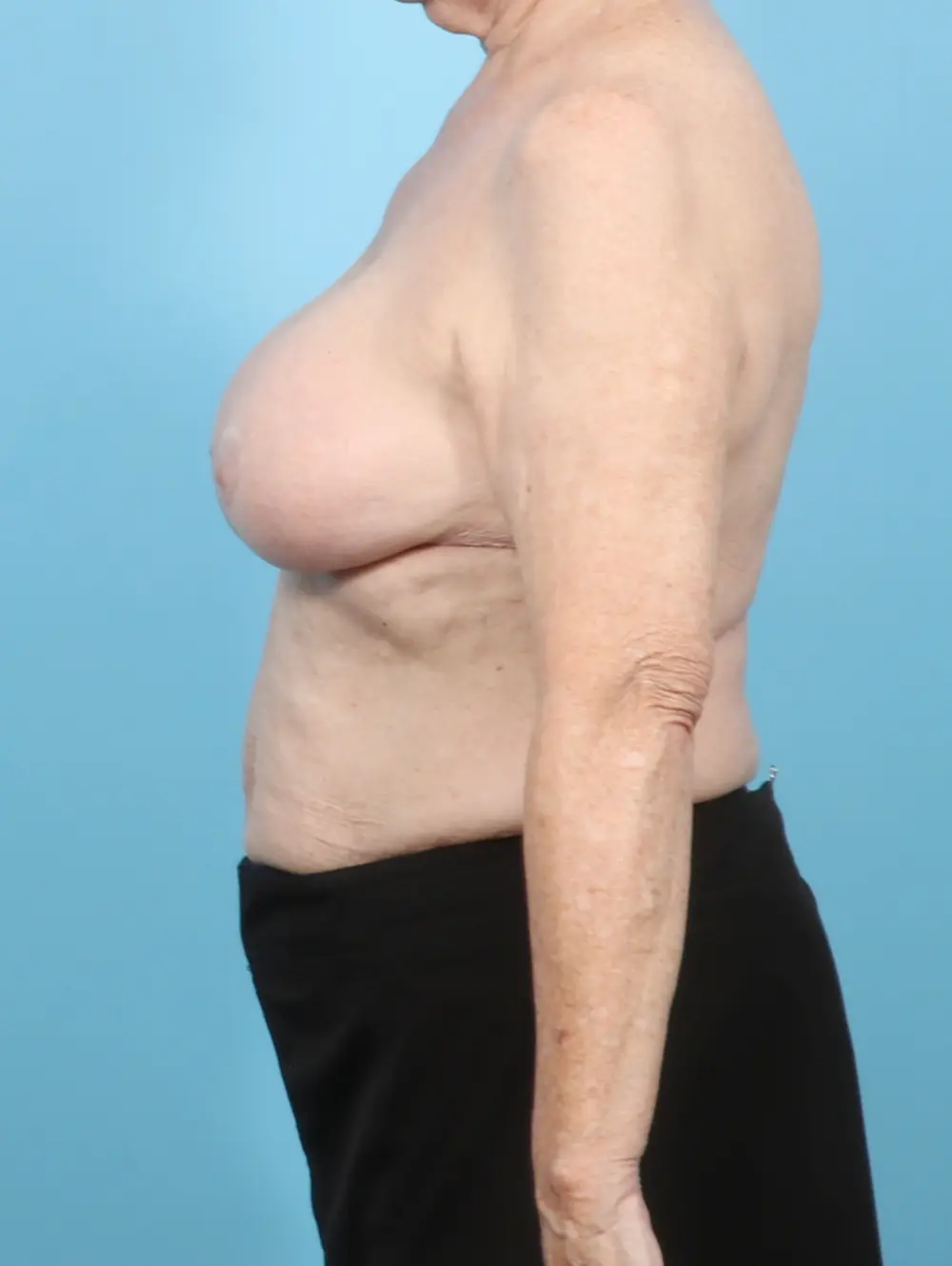 Breast Implant Removal Patient Photo - Case 56255 - before view-2