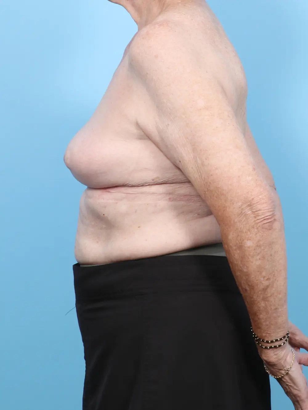 Breast Implant Removal Patient Photo - Case 56255 - after view-2