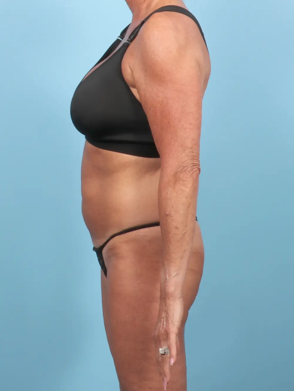 Tummy Tuck Patient Photo - Case 56290 - before view-2