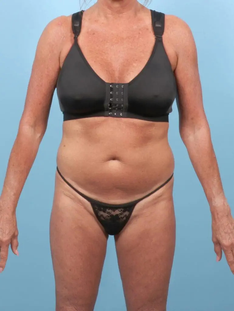 Tummy Tuck - Case 56290 - Before