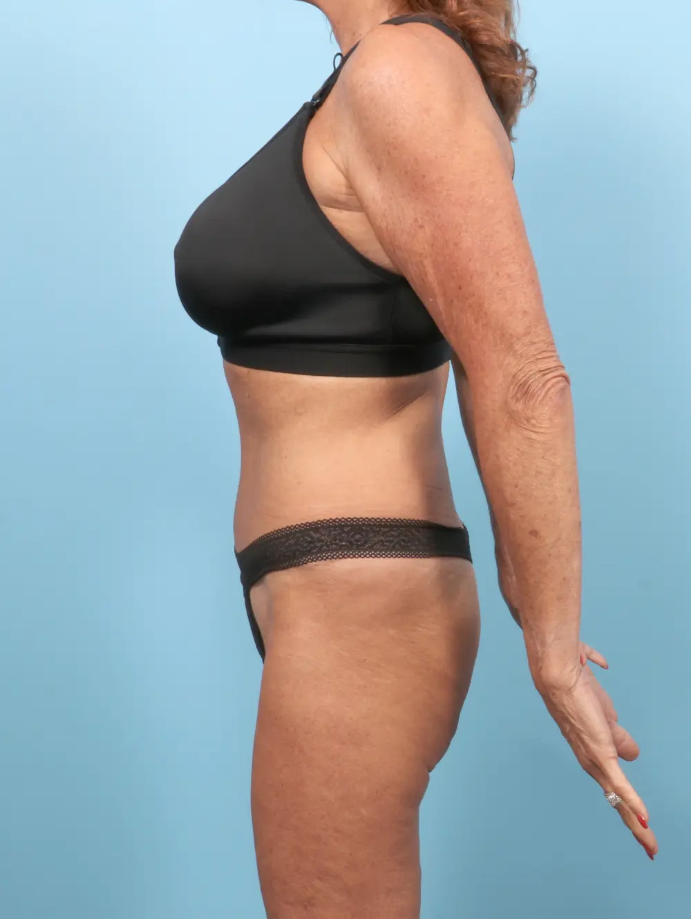 Tummy Tuck Patient Photo - Case 56290 - after view-2