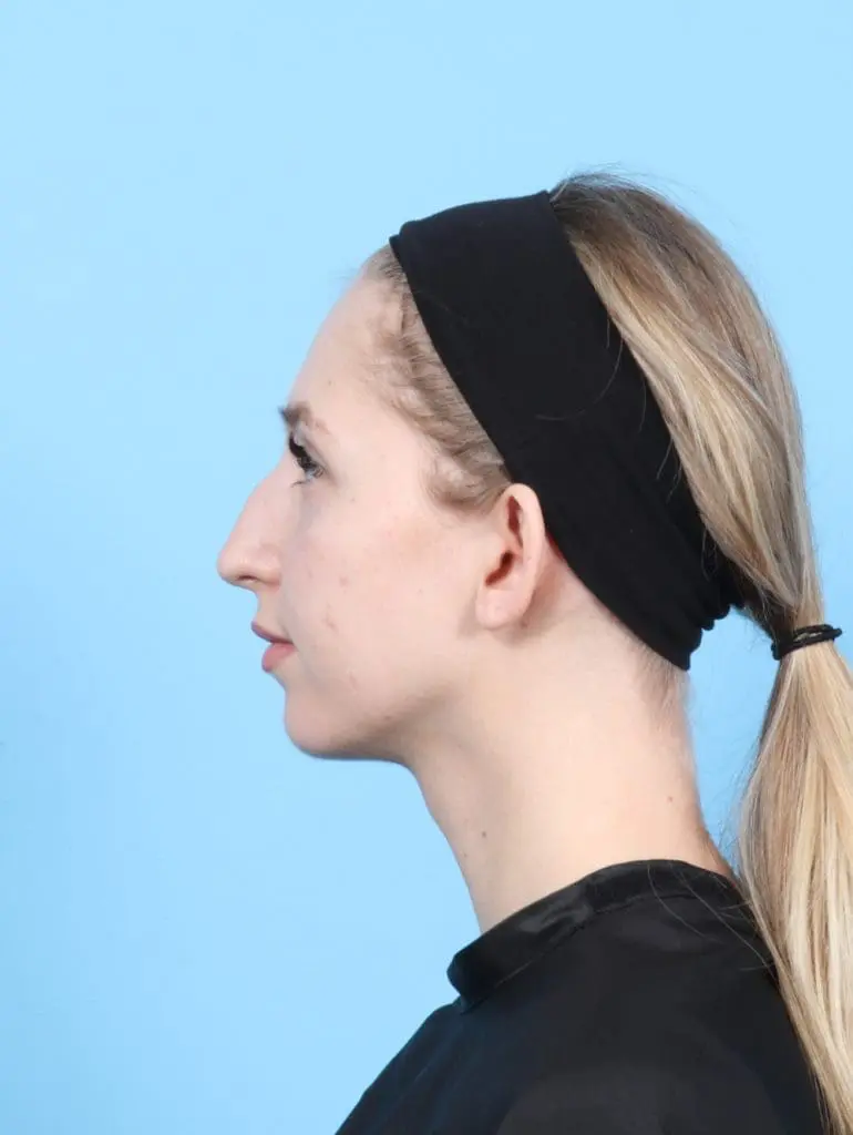 Rhinoplasty - Case 56298 - Before