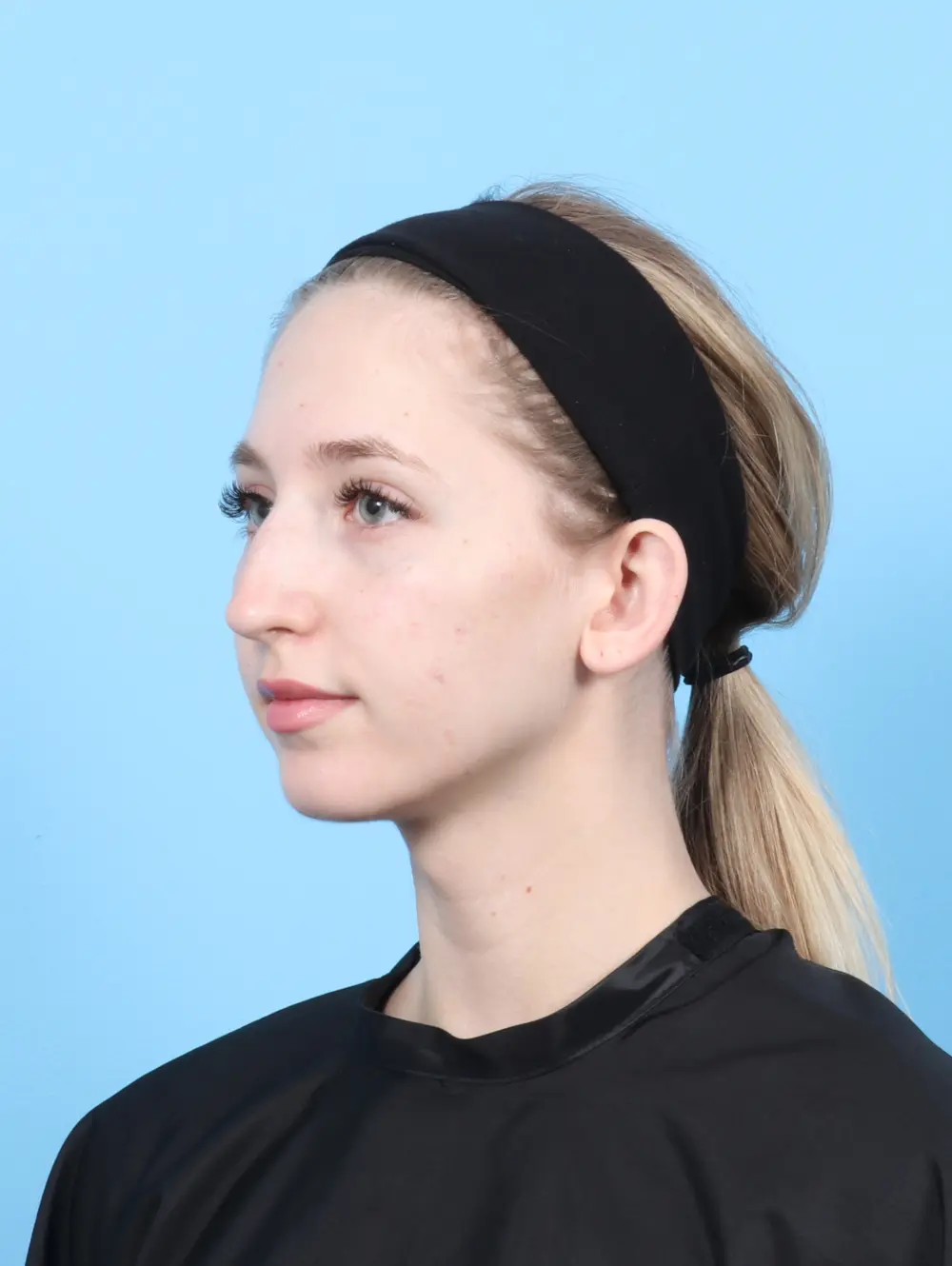 Rhinoplasty Patient Photo - Case 56298 - before view-1