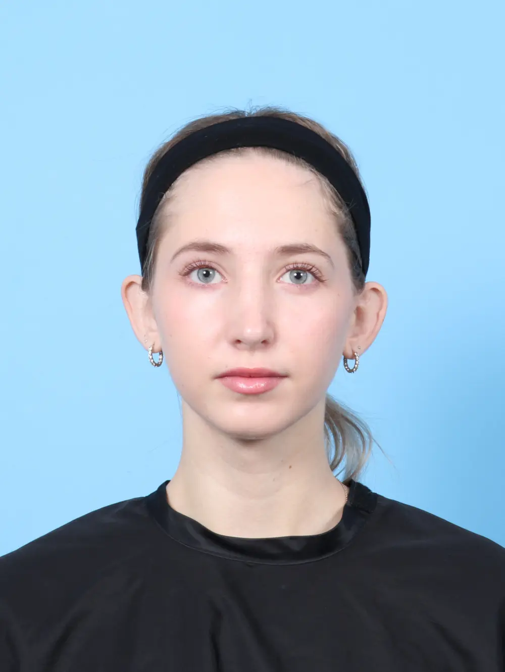 Rhinoplasty Patient Photo - Case 56298 - after view-2