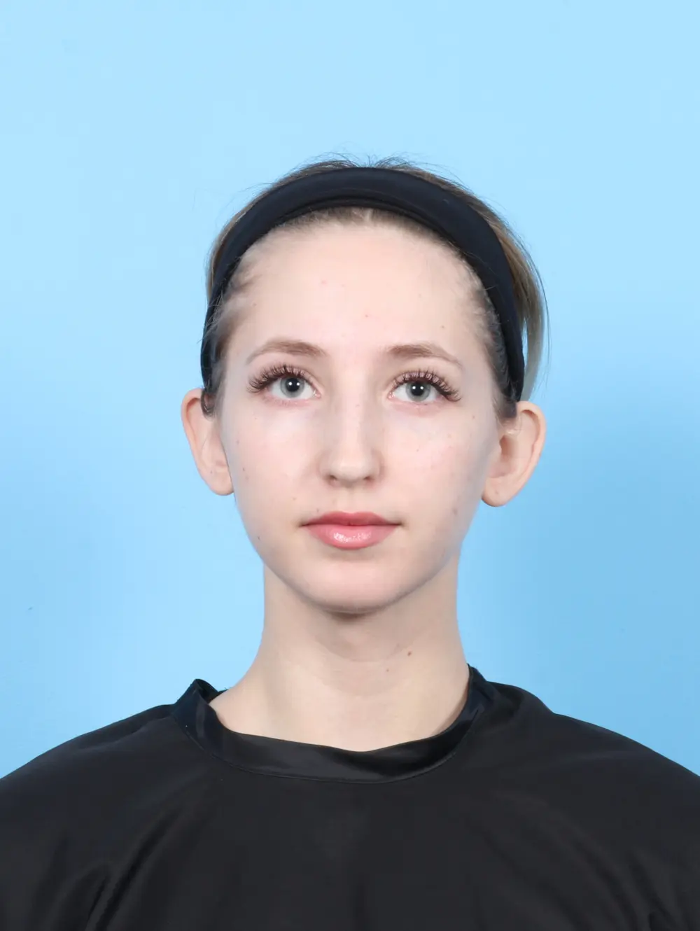 Rhinoplasty Patient Photo - Case 56298 - before view-2
