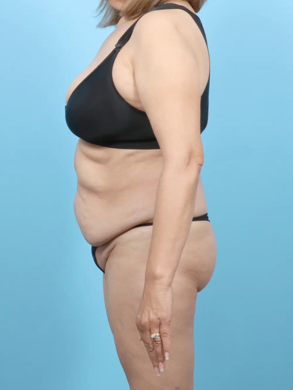 Tummy Tuck Patient Photo - Case 56322 - before view-2