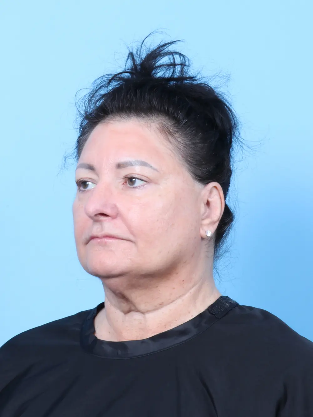 Eyelid Surgery Patient Photo - Case 56338 - after view-1