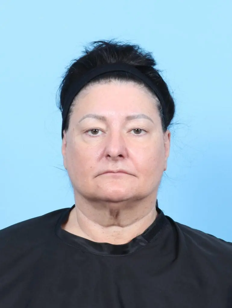 Eyelid Surgery - Case 56338 - Before