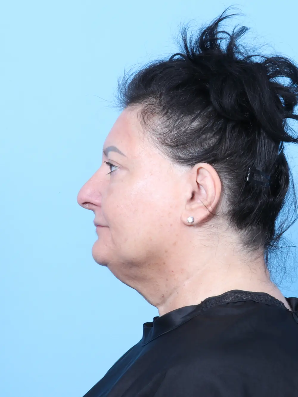 Eyelid Surgery Patient Photo - Case 56338 - after view-2
