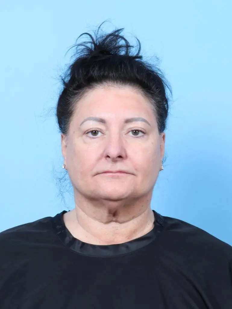 Eyelid Surgery - Case 56338 - After