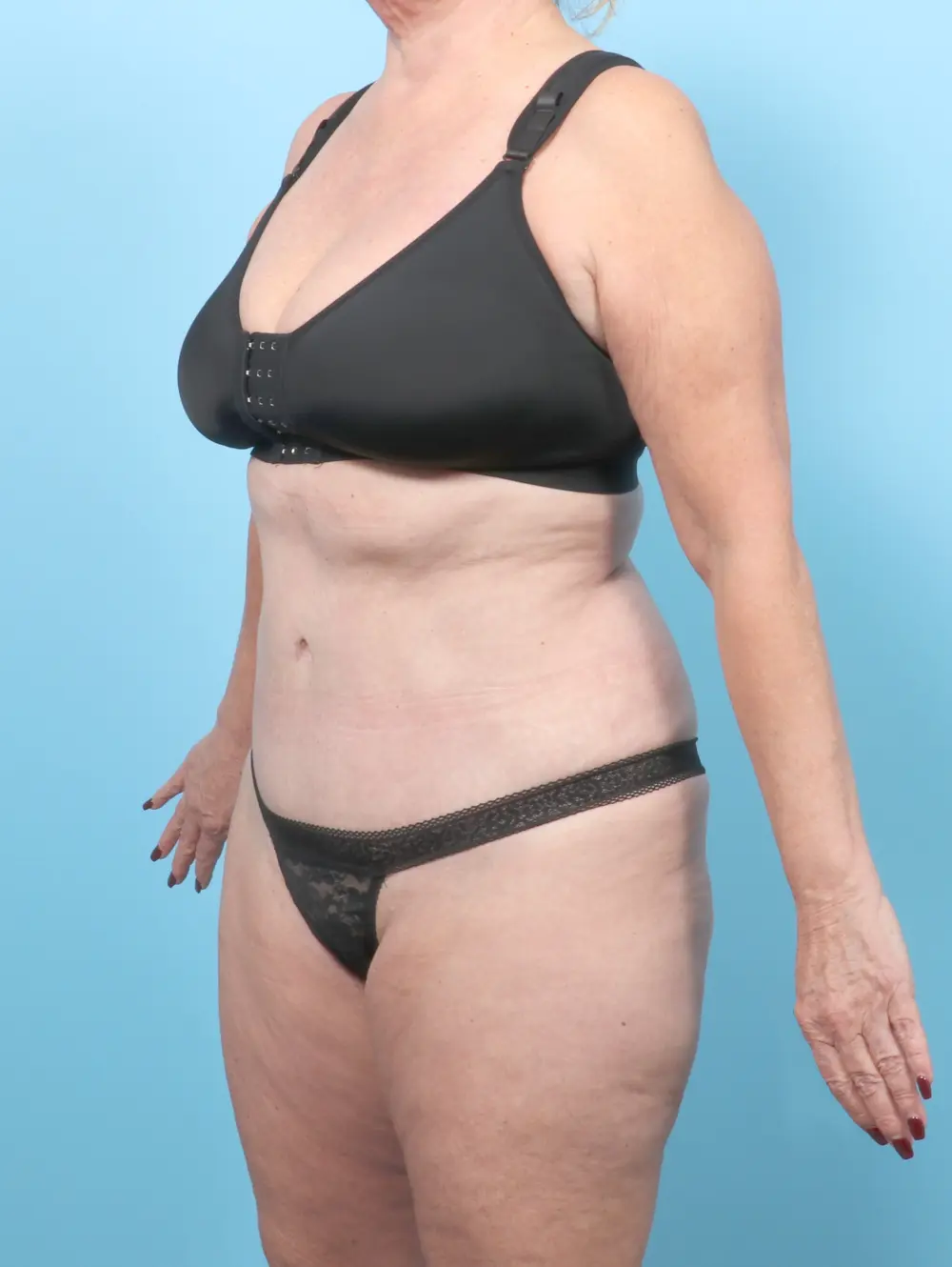 Tummy Tuck Patient Photo - Case 56346 - after view-1