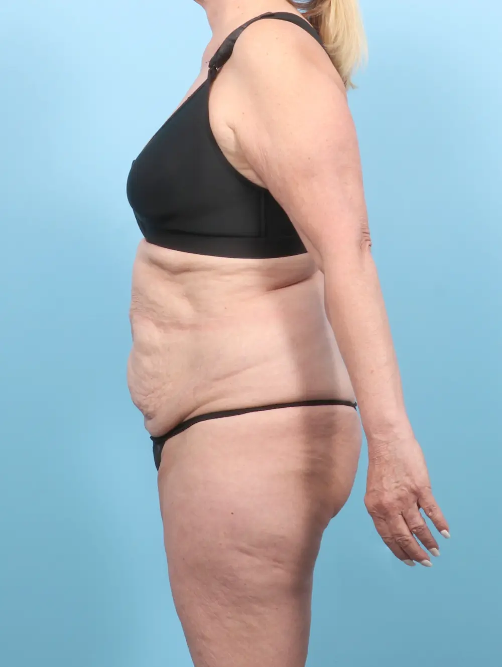 Tummy Tuck Patient Photo - Case 56346 - before view-2