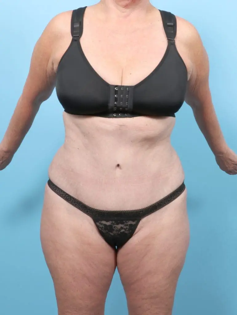 Tummy Tuck - Case 56346 - After
