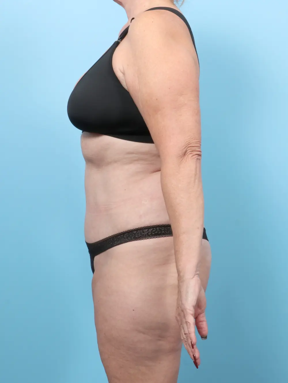Tummy Tuck Patient Photo - Case 56346 - after view-2