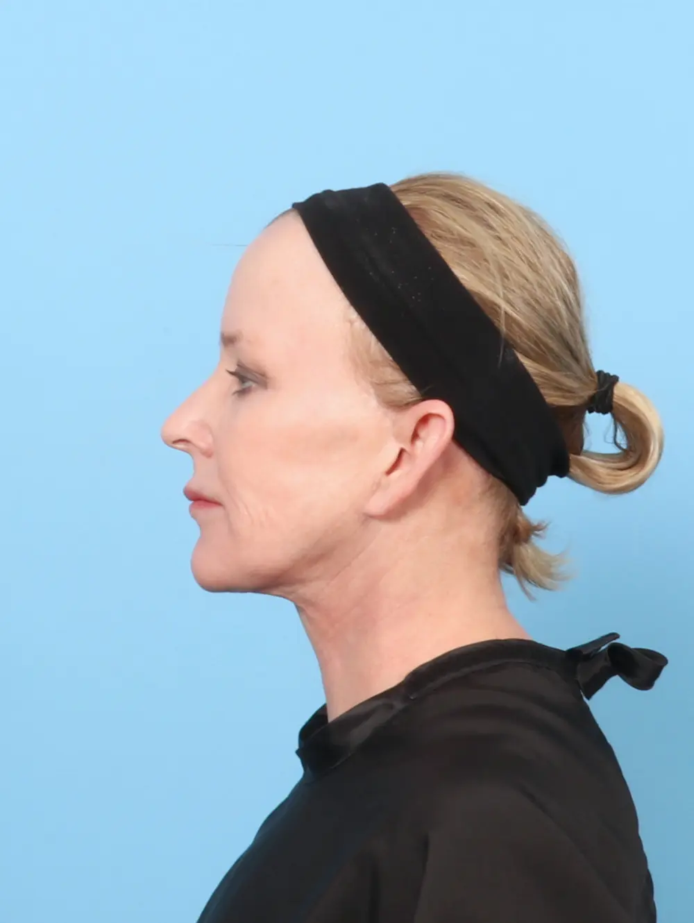 Eyelid Surgery Patient Photo - Case 56354 - before view-2