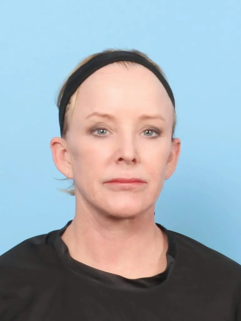 Eyelid Surgery - Case 56354 - Before