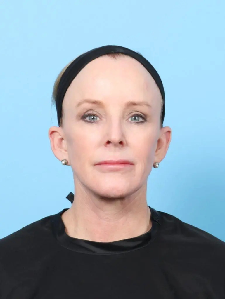 Eyelid Surgery - Case 56354 - After