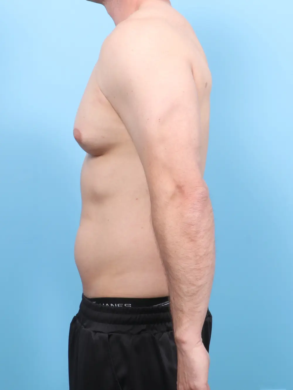 Gynecomastia Patient Photo - Case 56362 - before view-2