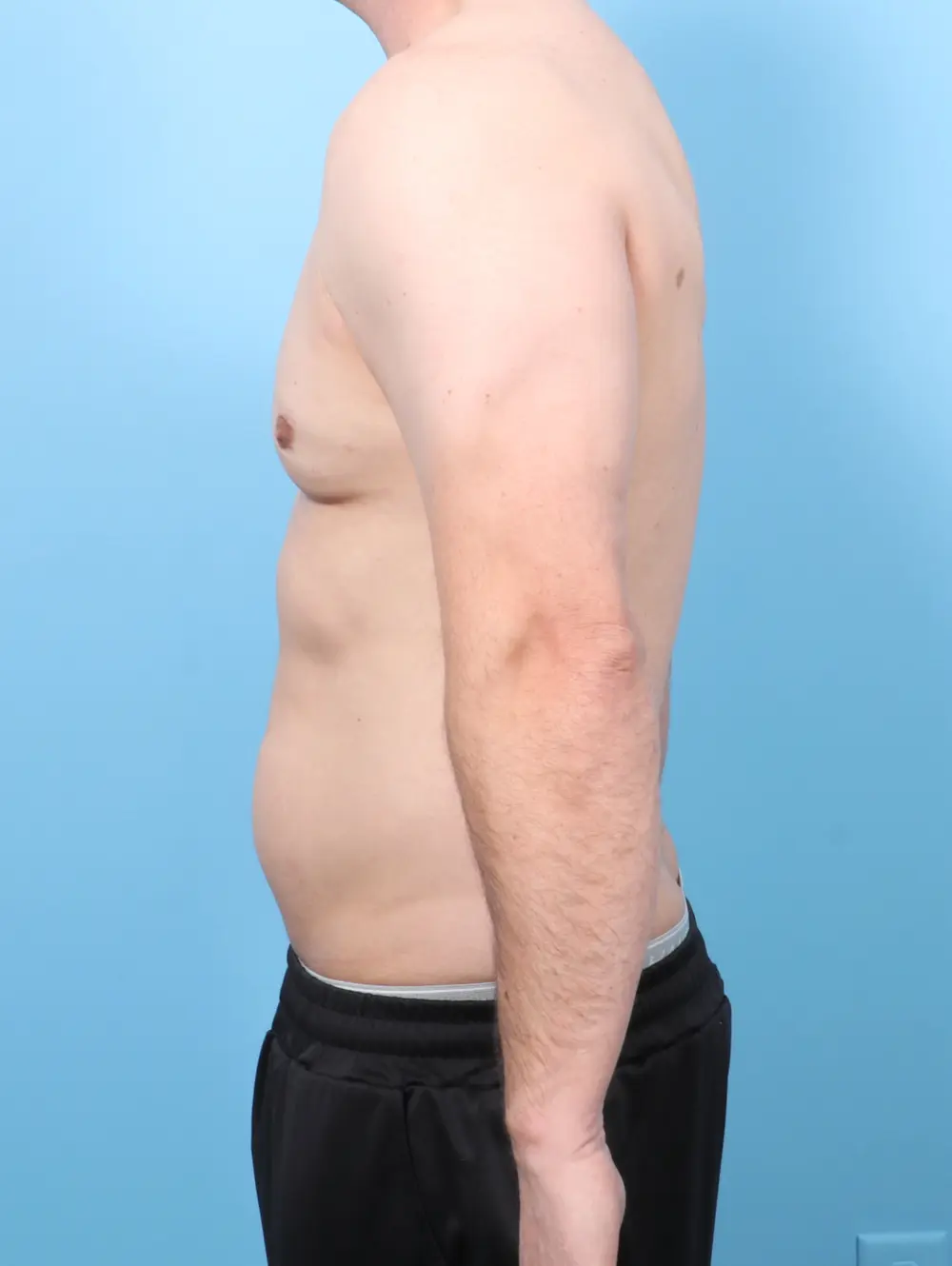 Gynecomastia Patient Photo - Case 56362 - after view-2