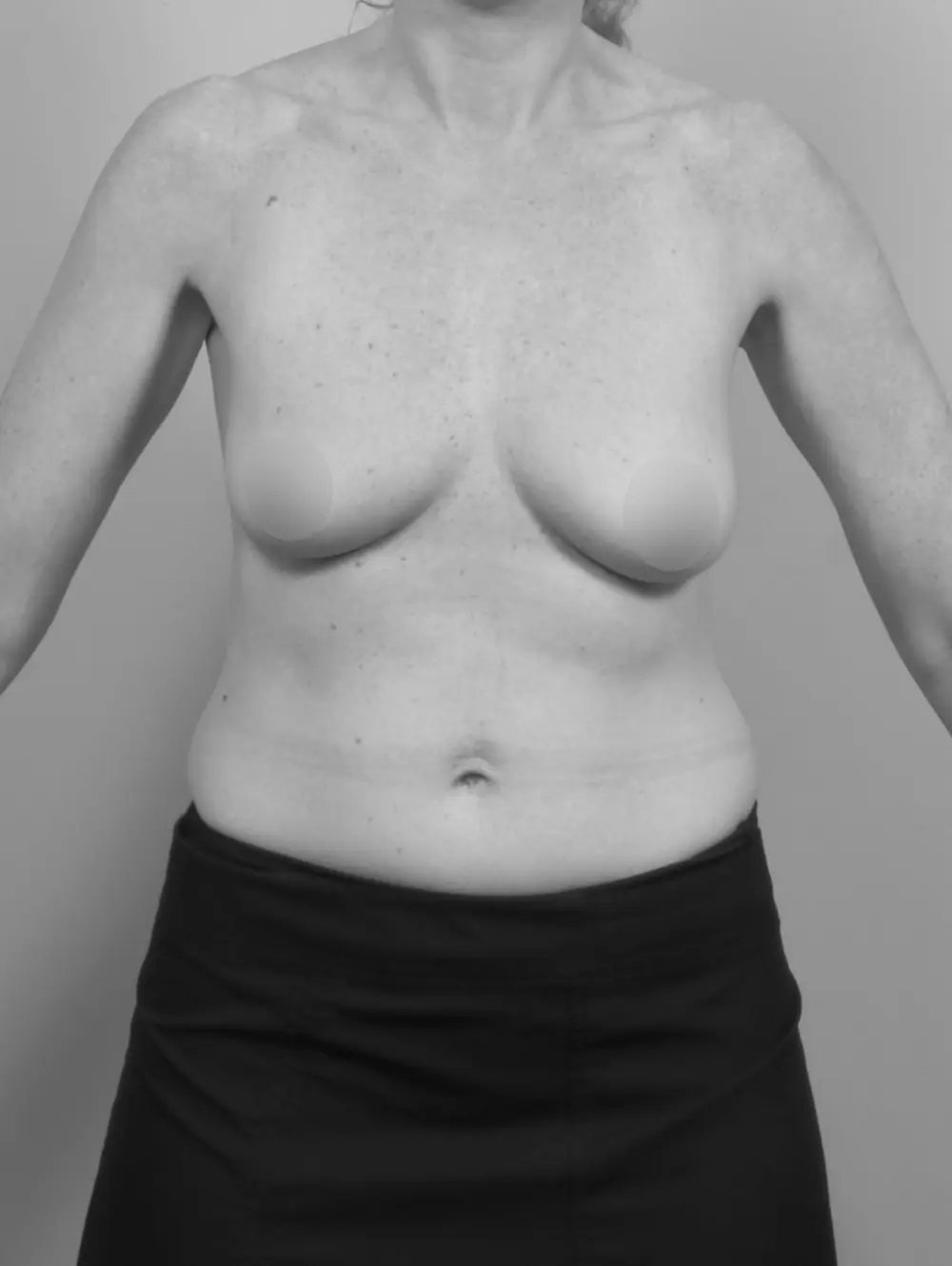 Before Breast Lift/Augmentation