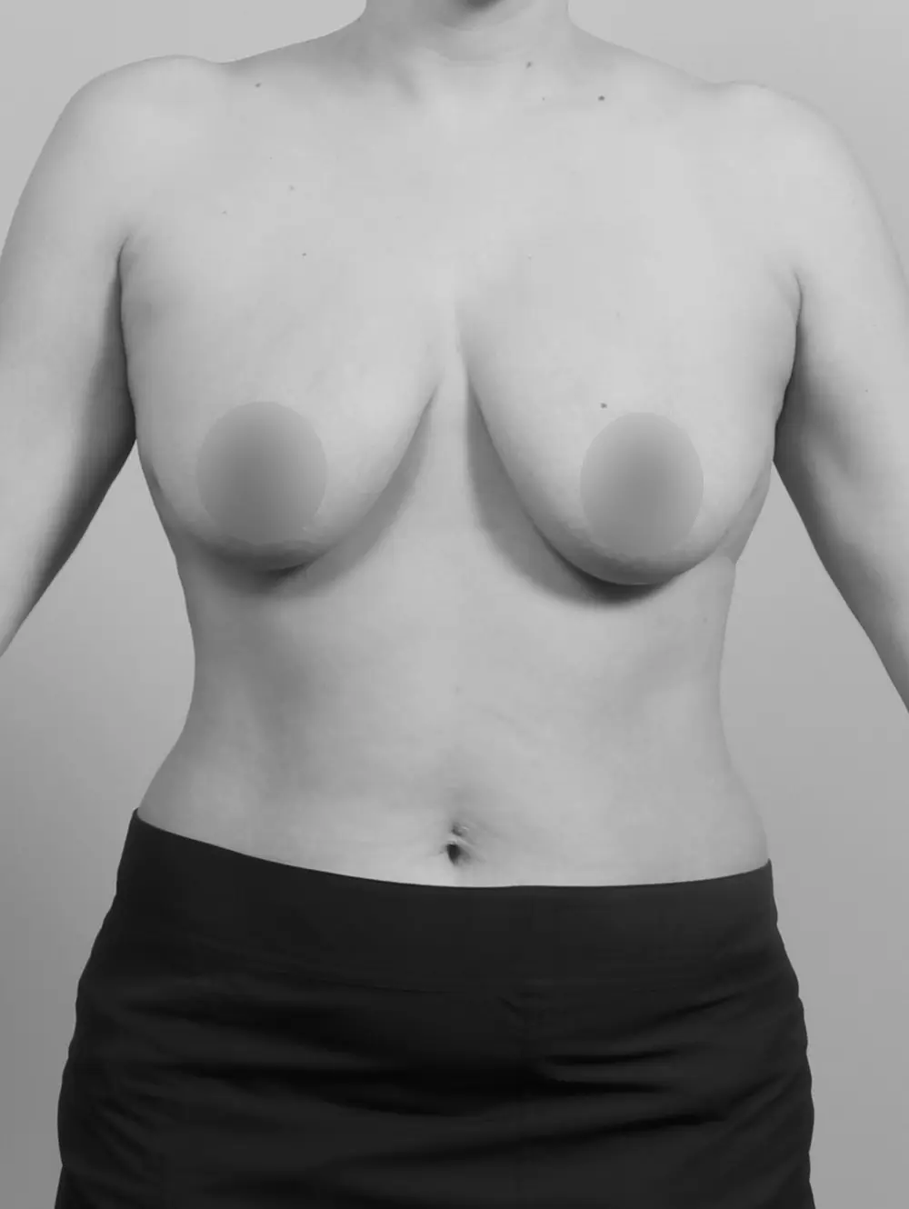 Before Breast Lift/Augmentation