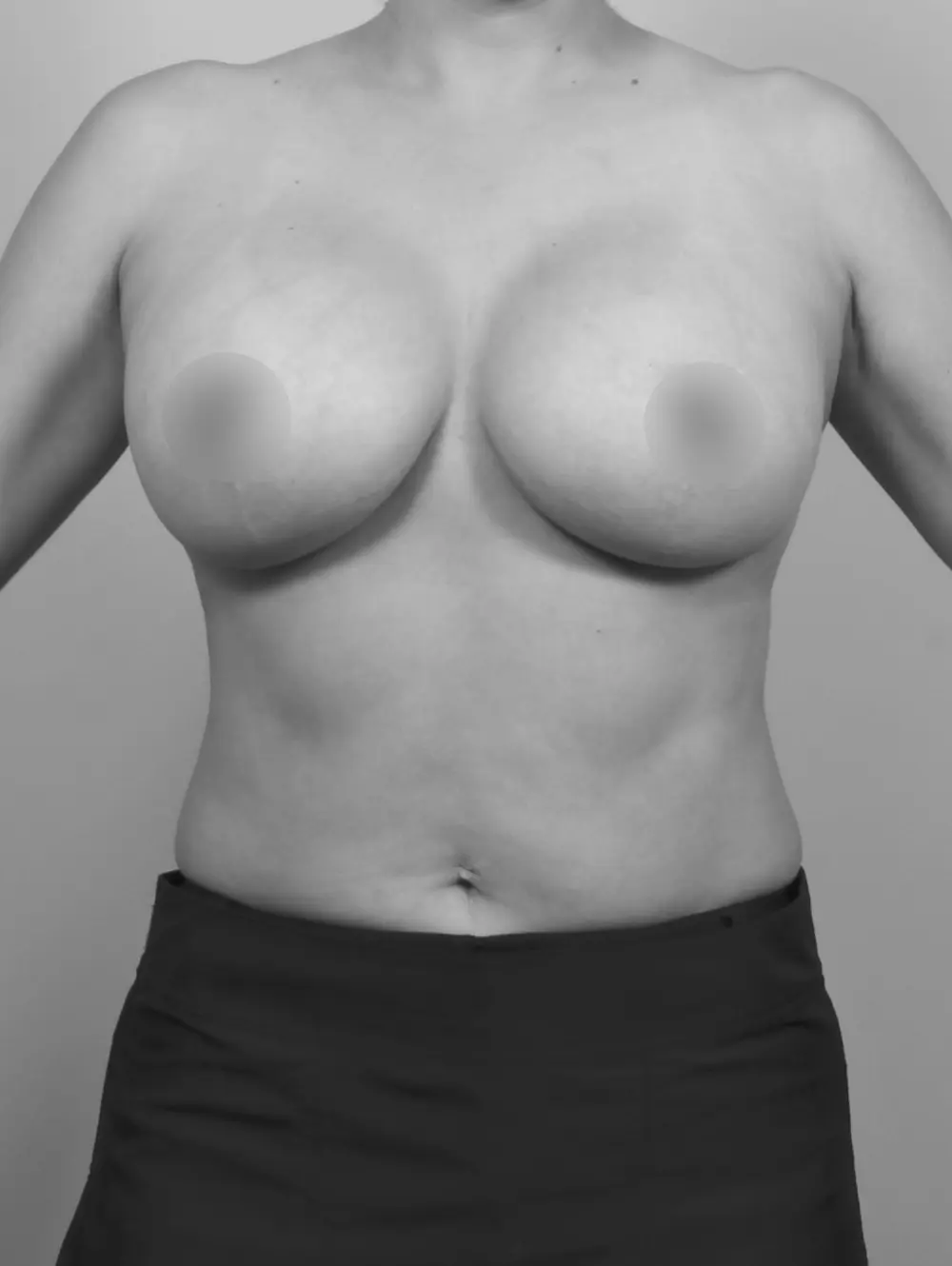 After Breast Lift/Augmentation