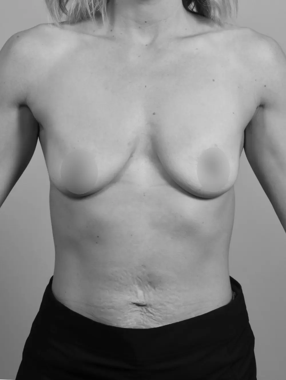 Before Breast Lift/Augmentation