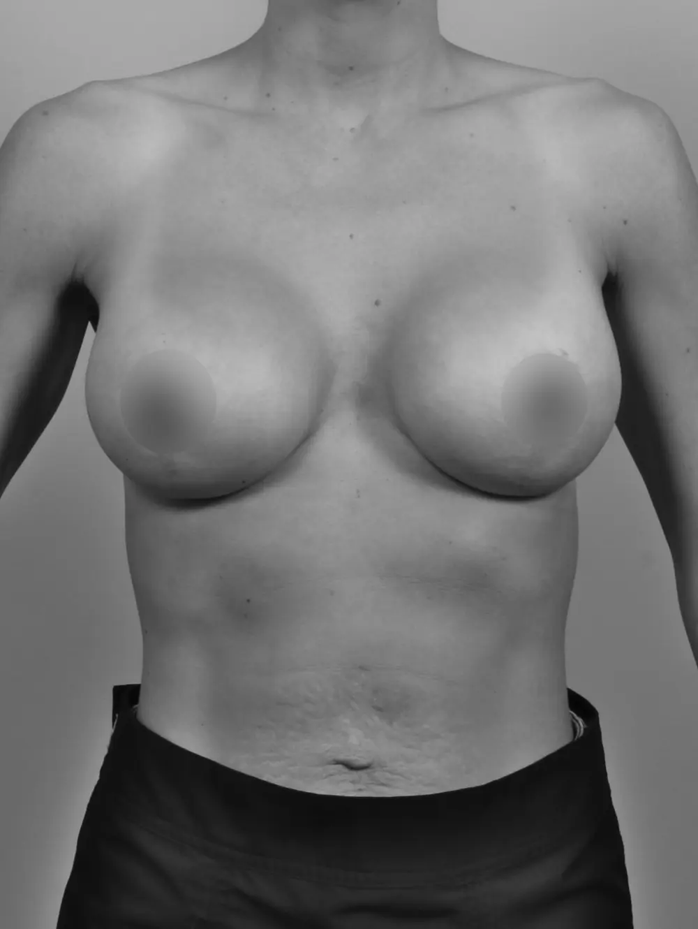 After Breast Lift/Augmentation