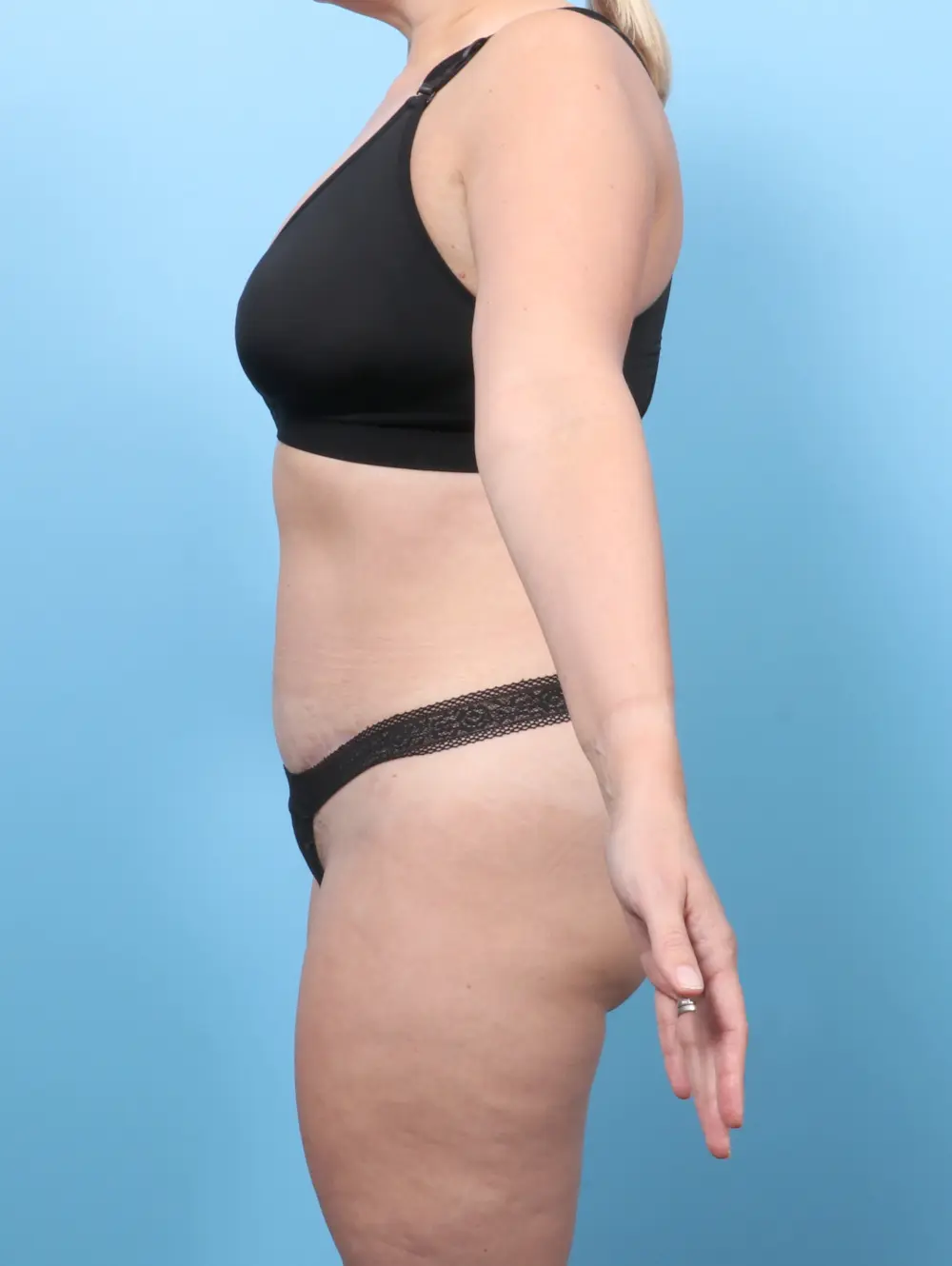 Tummy Tuck Patient Photo - Case 56475 - after view-2