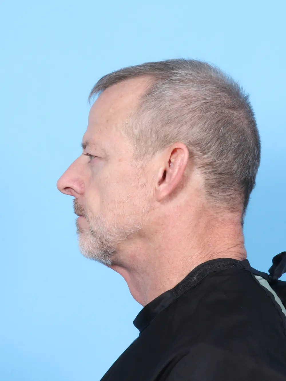 Eyelid Surgery Patient Photo - Case 56492 - before view-2