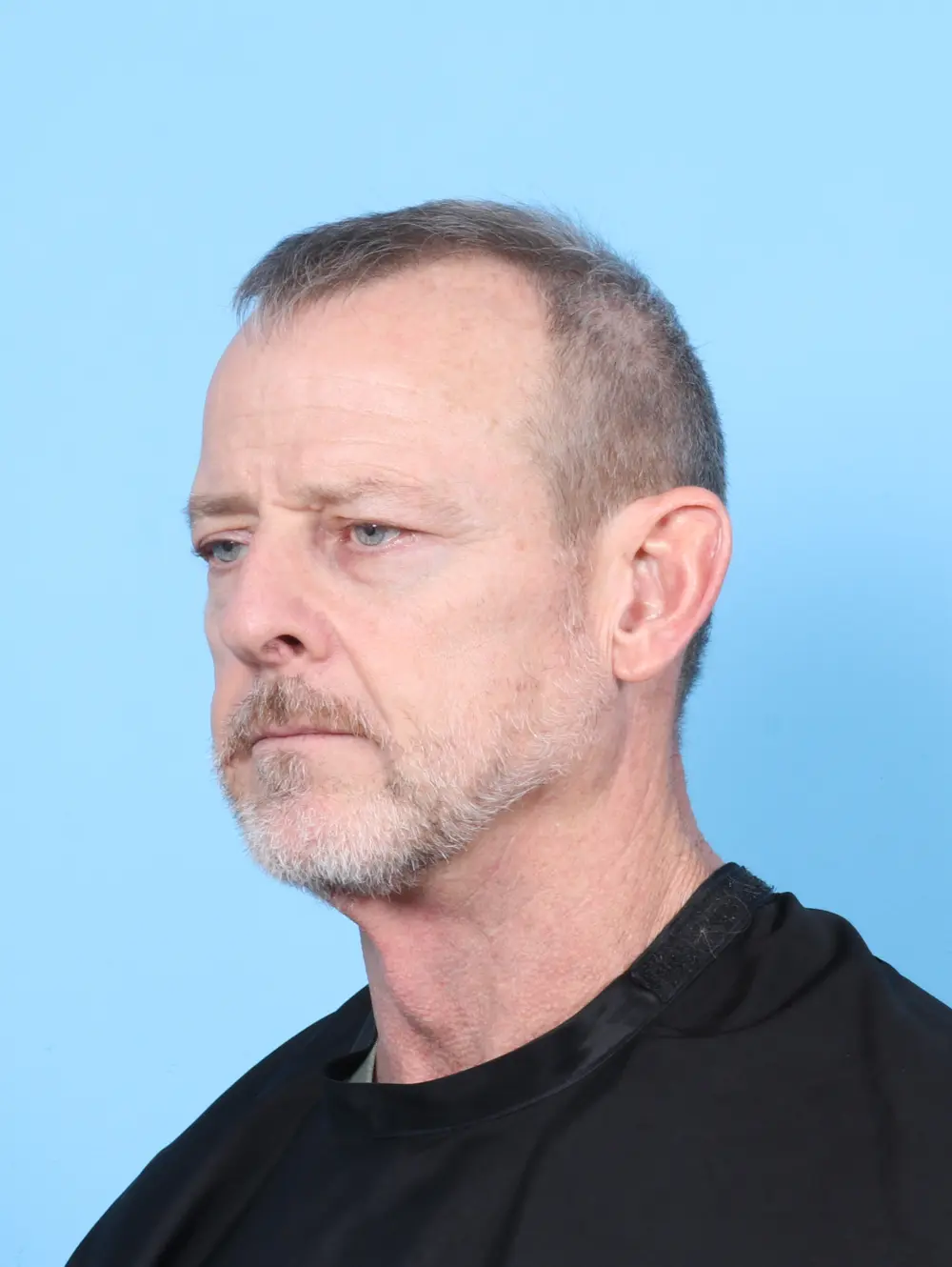 Eyelid Surgery Patient Photo - Case 56492 - before view-1