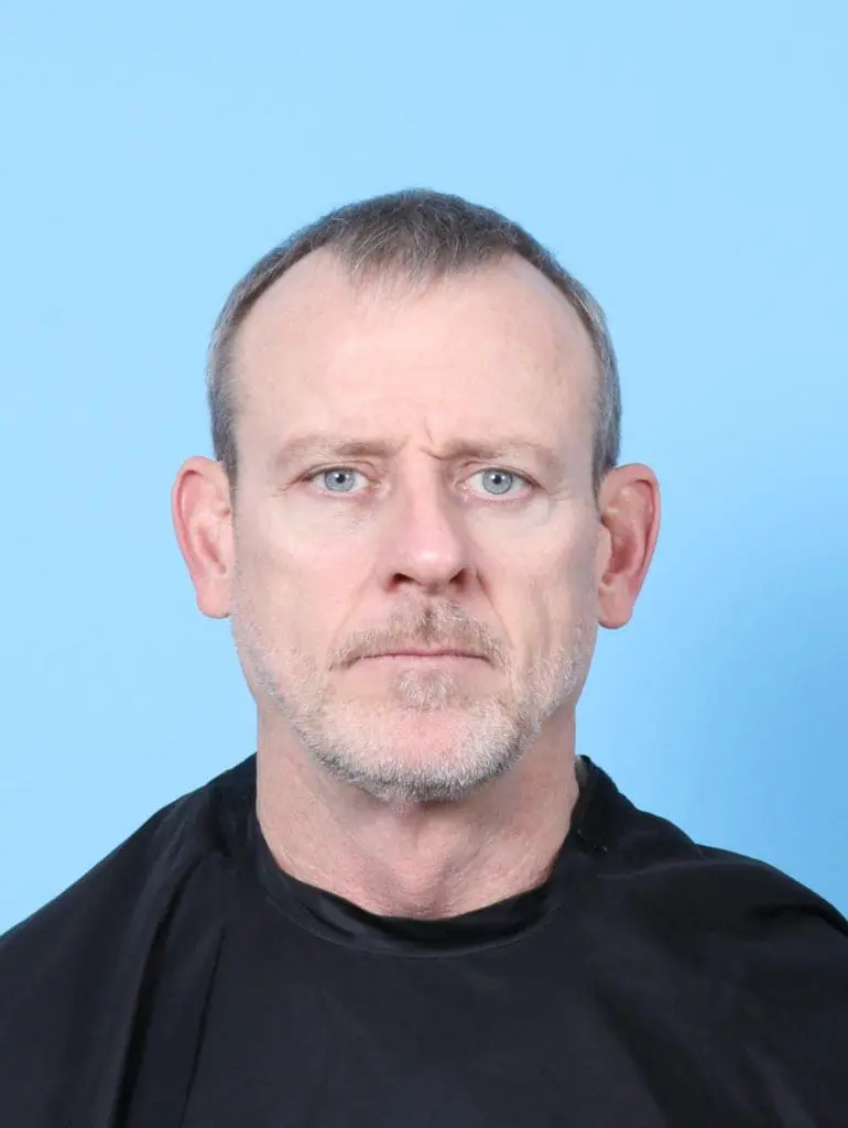 Eyelid Surgery - Case 56492 - After