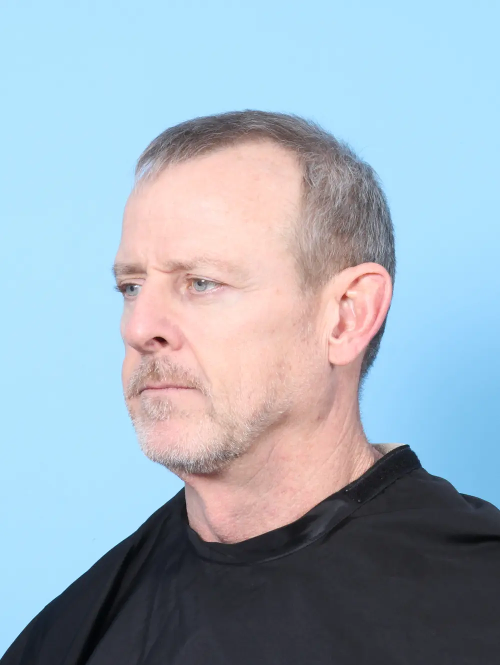 Eyelid Surgery Patient Photo - Case 56492 - after view-1