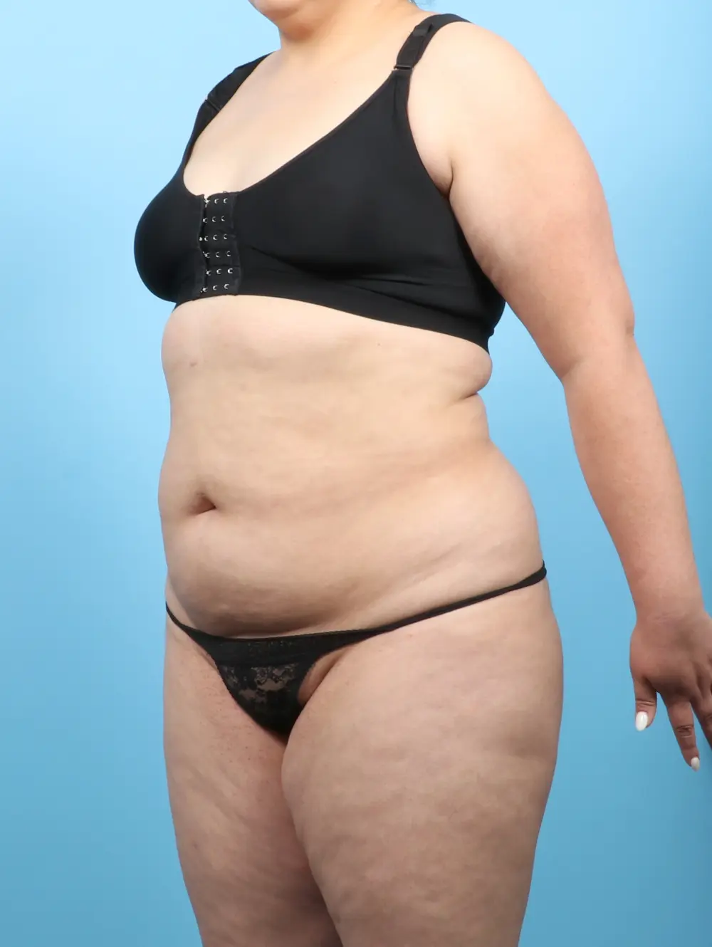 Liposuction Patient Photo - Case 56500 - before view-1