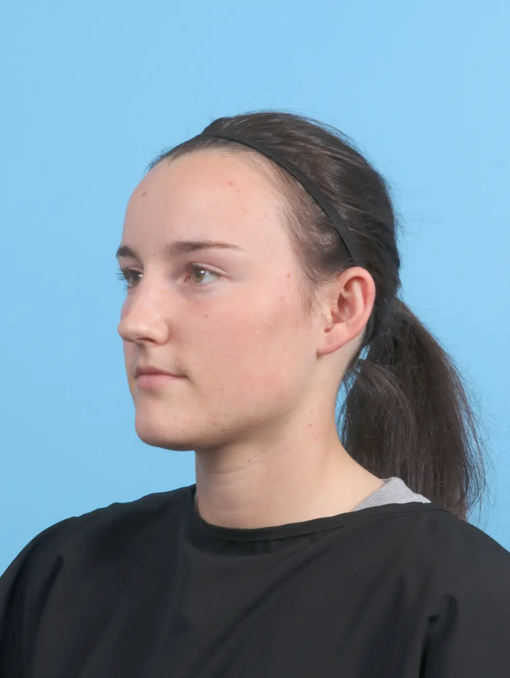 Otoplasty Patient Photo - Case 56560 - before view-1