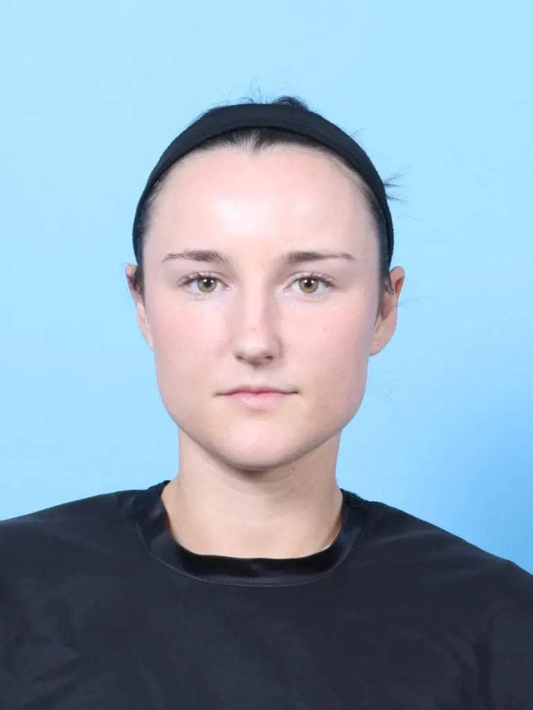 Otoplasty - Case 56560 - After